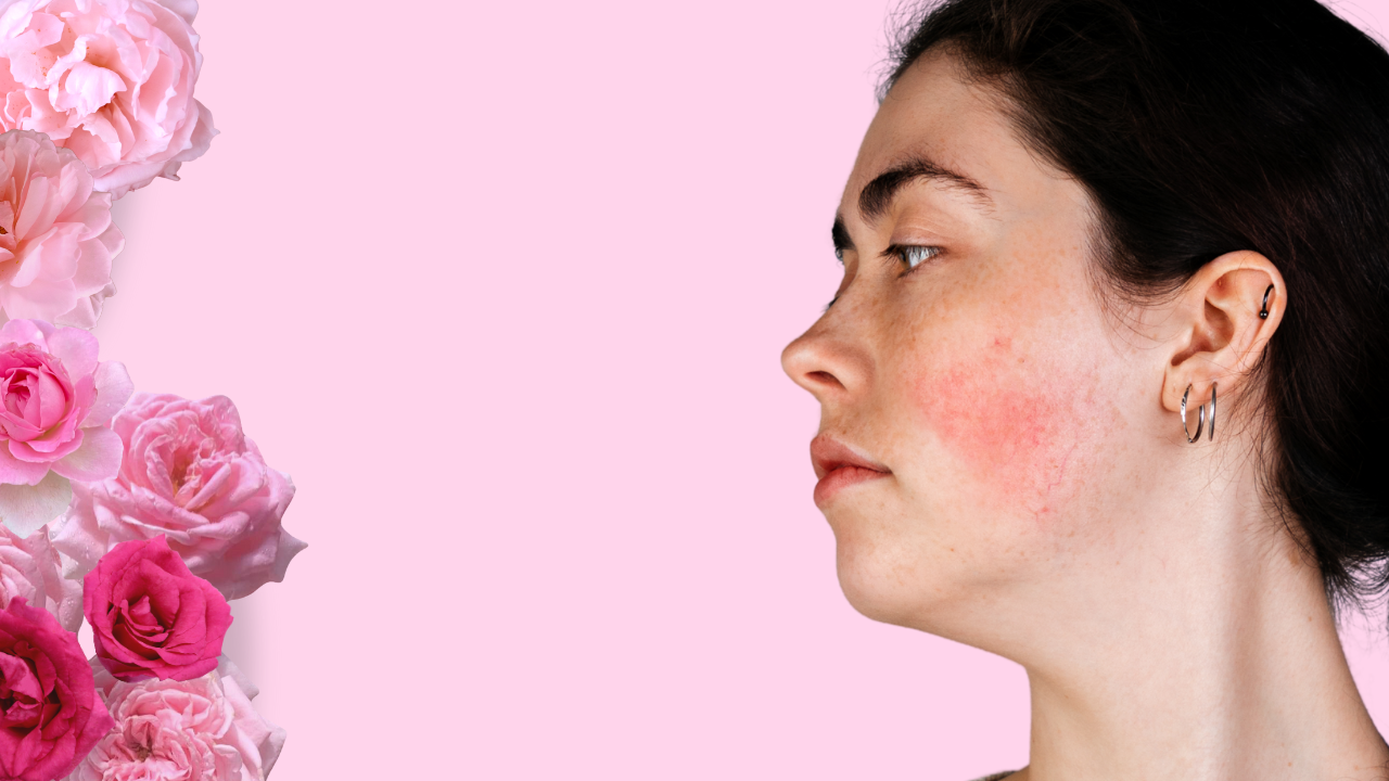 COUPEROSA-IHON HOITO